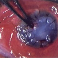 תמונה מהמאמר המדגימה השתלת קרום השפיר בכיב של הקרנית.