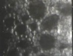 תמונה 6 - תאי האנדותל ב- Fuchs dystrophy.